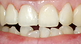 Аномальное расположение одного или нескольких зубов